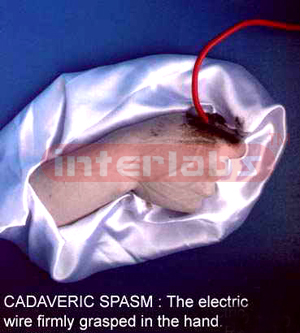Cadaveric spasm in a case of electrocution